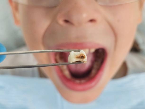 Best Urgent Care for Lost Fillings or Crowns in Port Vue, PA